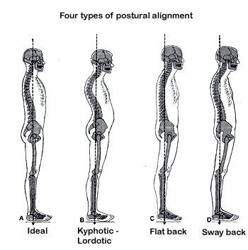  may pull the pelvis into a posterior tilt (see flat back diagram).