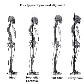 Posture - 4 typical types