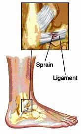 Sprain